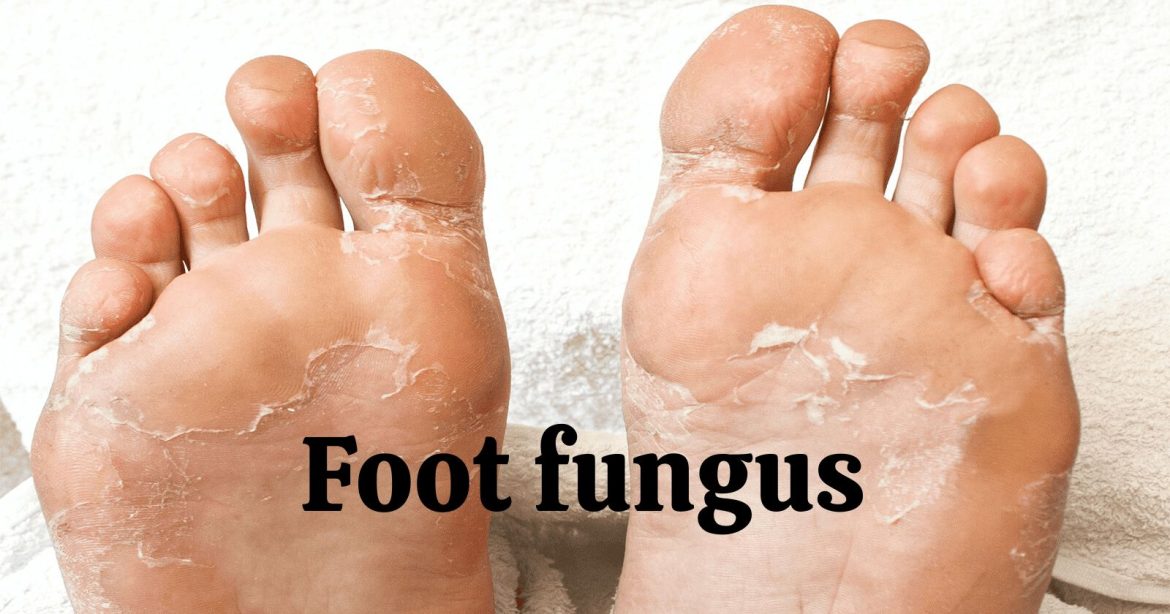 Anfangsstadium: Recognizing the Early Signs of Foot Fungus